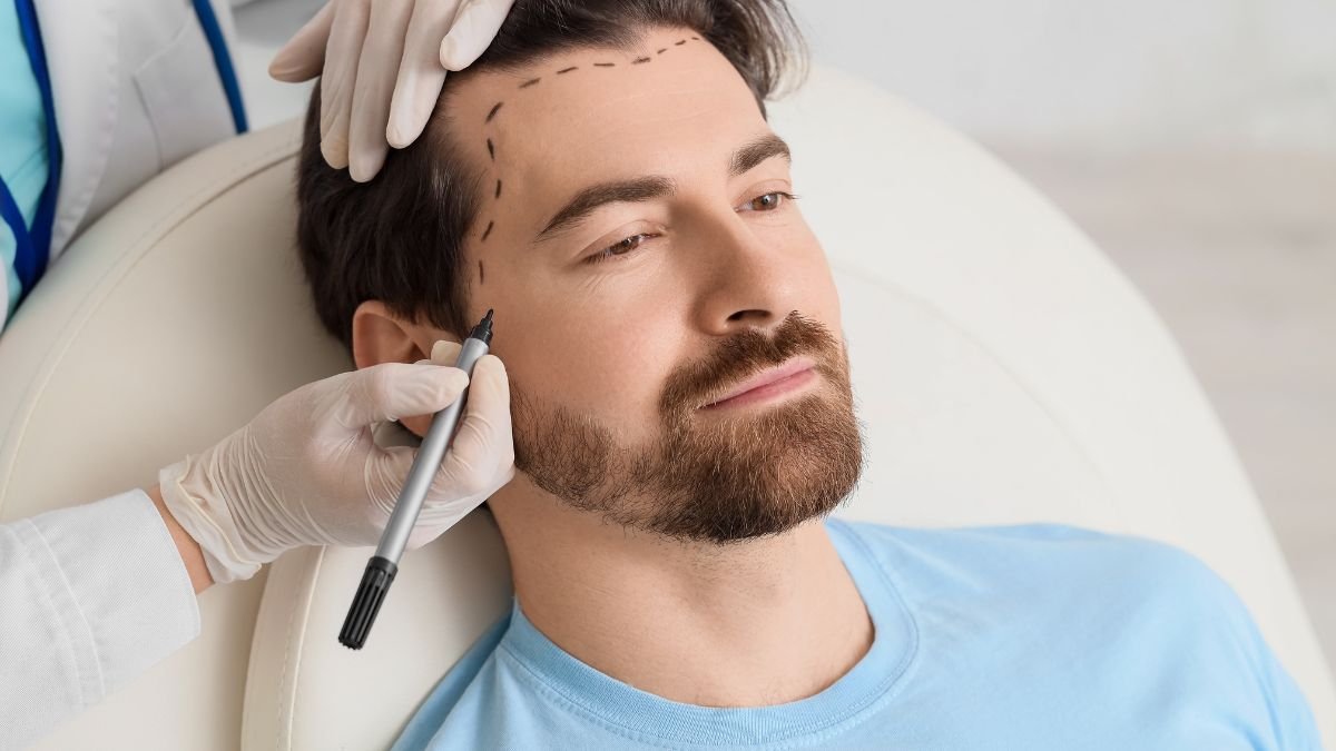 Transplante Capilar: Solução Definitiva Para a Queda de Cabelo? Guia Completo Bem Viver Hub