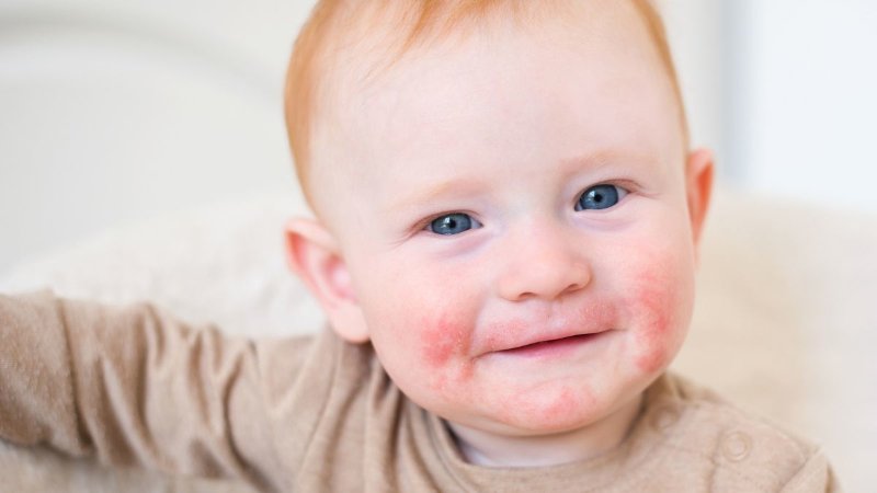 Dermatite Atópica em Bebês e Crianças: Sintomas, Cuidados e Quando se Preocupar