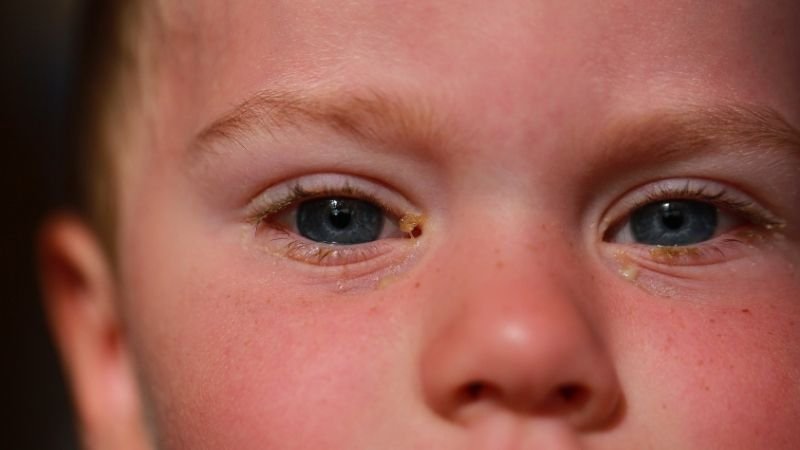 Olhos Vermelhos em Crianças: Quando Levar ao Médico